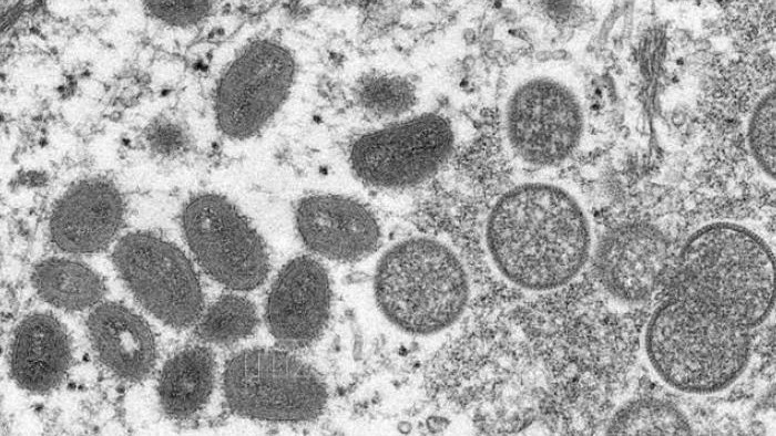 Image microscopique montrant le virus de la variole du singe dans un échantillon de patient. Photo : Reuters